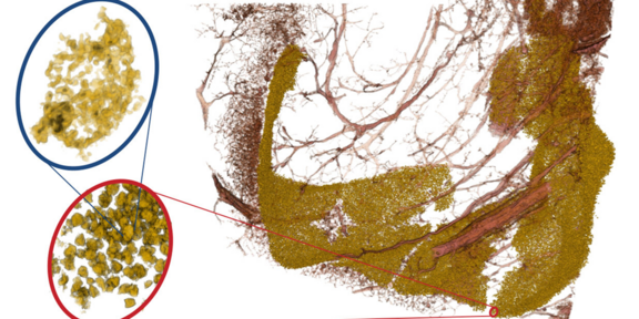 3D visualisation of human neuronal tissue reconstructed by multi-scale X-ray phase contrast tomography. Neuronal cell nuclei are shown in yellow for the granule neurons in the dentate gyrus region of the hippocampus. Blood vessels are shown in red. By changing the X-ray optical magnification in the multi-scale recordings, one can zoom   into regions-of-interest (red ovals). In these scans the resolution is high enough to resolve sub-structures of the nucleus, associated with different DNA packing regimes. Adapted from [6]